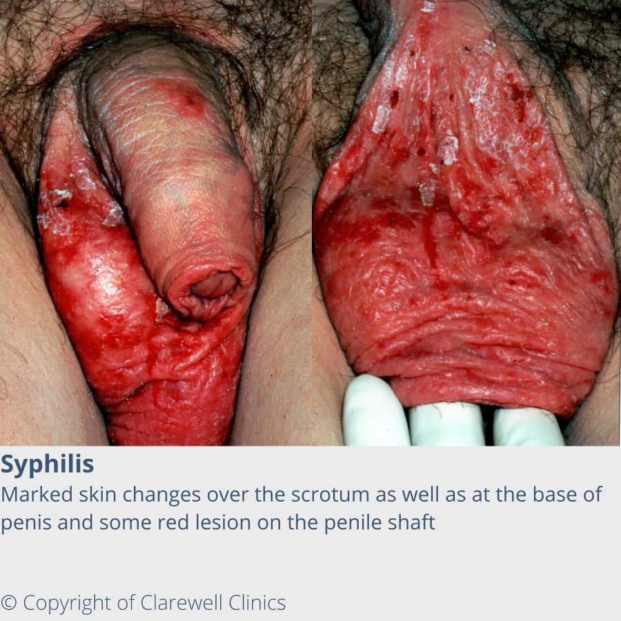 Syphilis - Marked skin changes over the scrotum as well as at the base of penis and some red lesion on the penile shaft